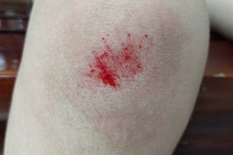 跌伤膝盖皮肤擦伤渗血图