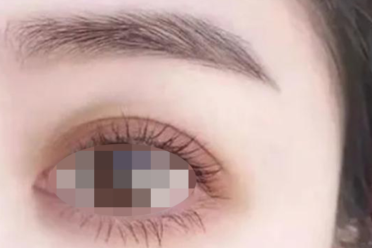 平行型双眼皮图