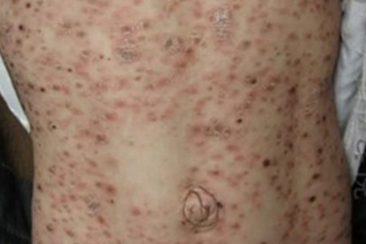 丘疹坏死性结核疹腹部丘疹图