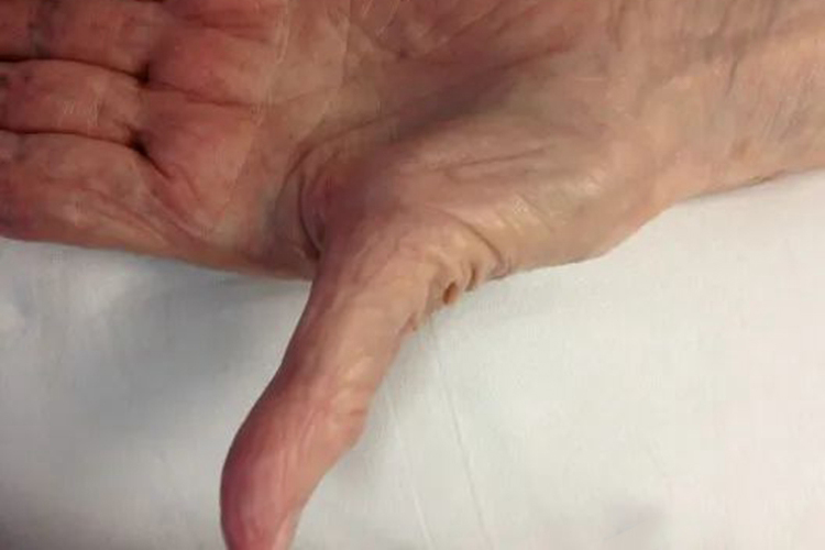 手部肌肉萎缩图