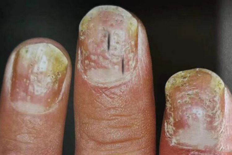 甲银屑病指甲下线状出血图