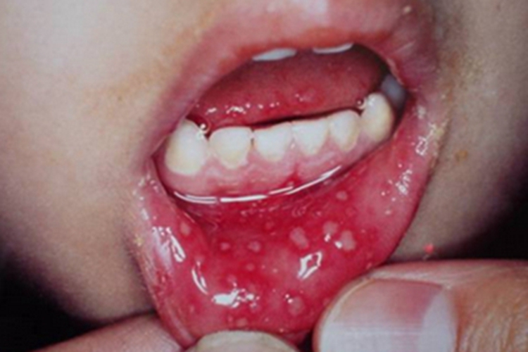 线状lgA大疱性皮病嘴唇溃疡图 线状lgA大疱性皮病嘴唇溃疡图