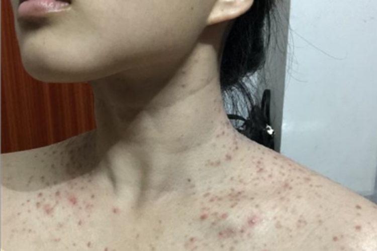 马拉色菌毛囊炎肩部疙瘩图