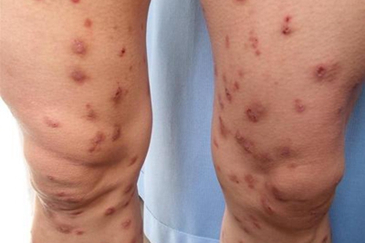 痒疹腿部症状图