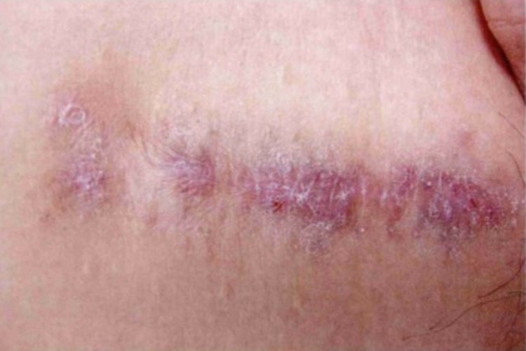 皮肤子宫内膜异位症瘢痕图 皮肤子宫内膜异位症瘢痕图