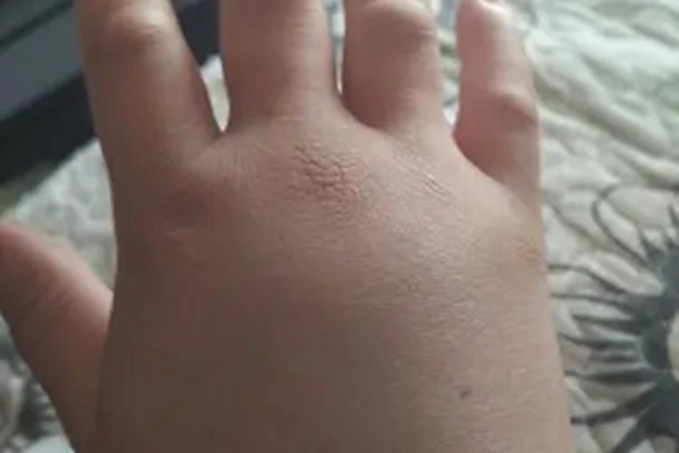 特发性水肿手部胖一圈图