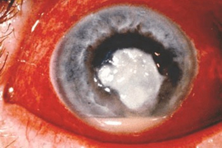 棘阿米巴角膜炎溃疡图 棘阿米巴角膜炎溃疡图