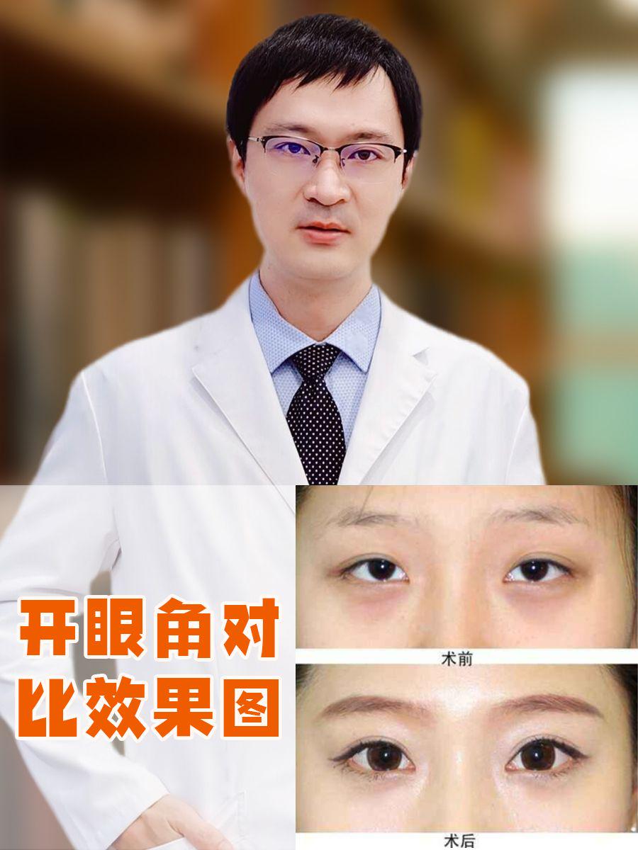 开眼角对比效果图