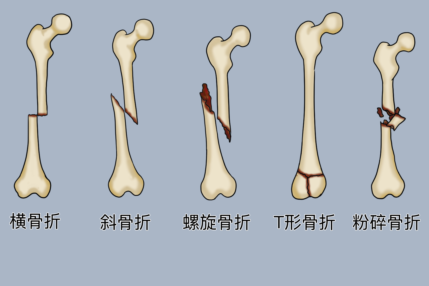 骨折线图 骨折线图