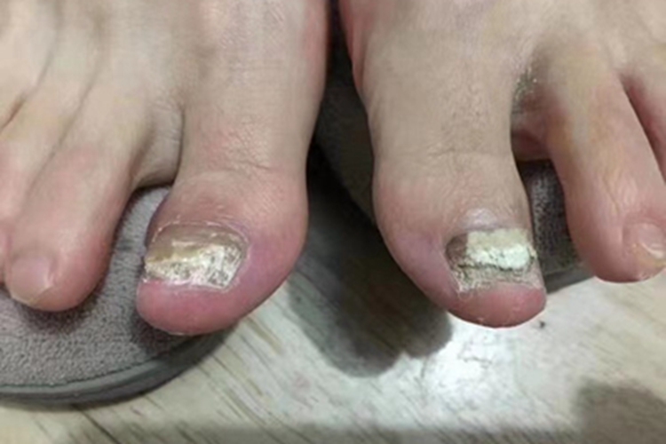 全甲损毁型甲真菌病脚趾甲缺损图