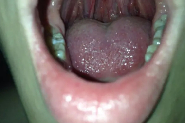 舌头位置图 舌头位置图