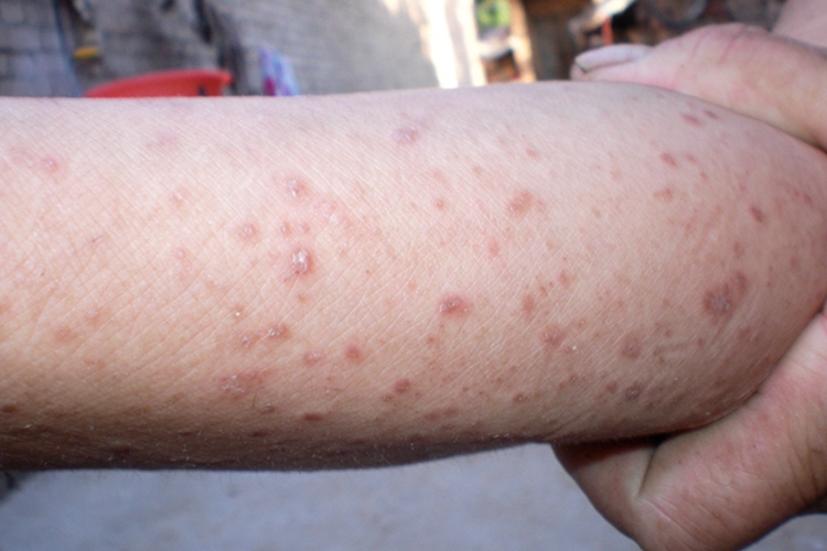 梅毒小腿疙瘩图