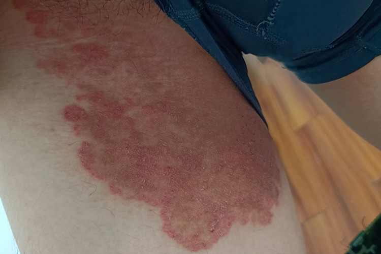 女性大腿根部慢性湿疹图