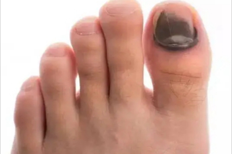 夹伤左脚大脚趾发黑图