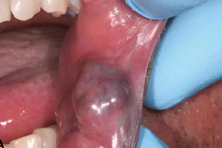 口腔混合血管瘤早期图
