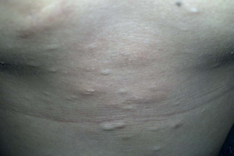 浅表性皮肤脂肪瘤痣腹部小疙瘩图 浅表性皮肤脂肪瘤痣腹部小疙瘩图