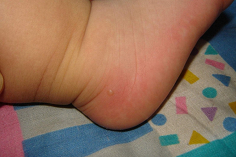 手足口病脚部症状图