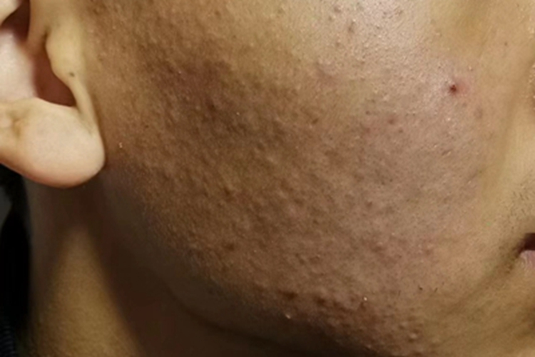 痤疮右脸长满了粉刺图