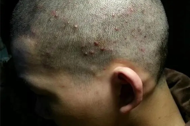 毛囊炎头皮红疙瘩图