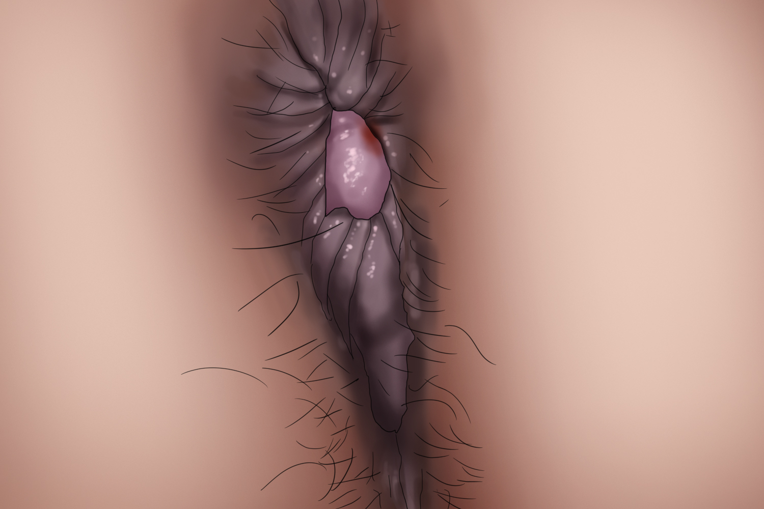 内痔长疙瘩手绘图