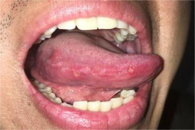 白塞病舌头侧边溃疡图