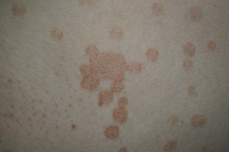 艾滋病褐色斑块图 艾滋病褐色斑块图