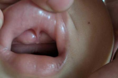 乳牙萌出鼓牙包图