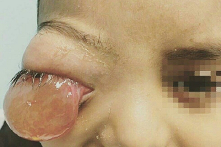 眼眶肿瘤症状图 眼眶肿瘤症状图