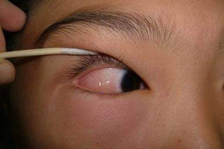 罗阿丝虫病血丝图 罗阿丝虫病血丝图