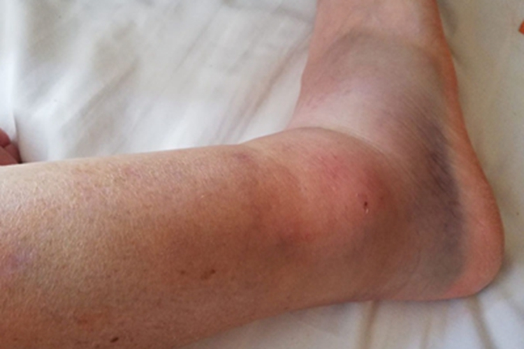 踝扭伤斑图 踝扭伤斑图