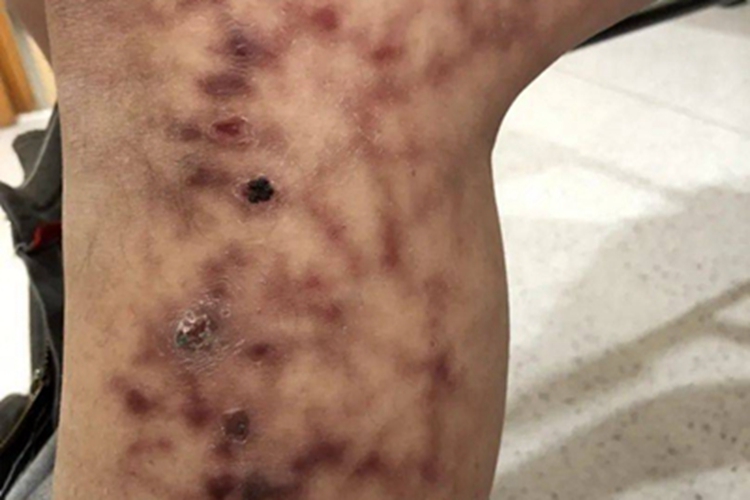 火激红斑小腿纹图 火激红斑小腿纹图