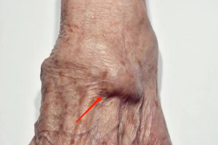 足背腱鞘炎左脚脚背疼位置图