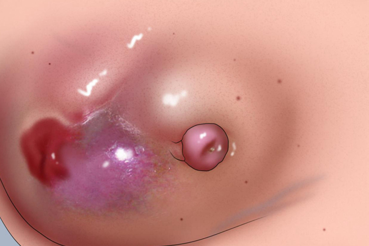 急性乳腺炎奶头有脓图