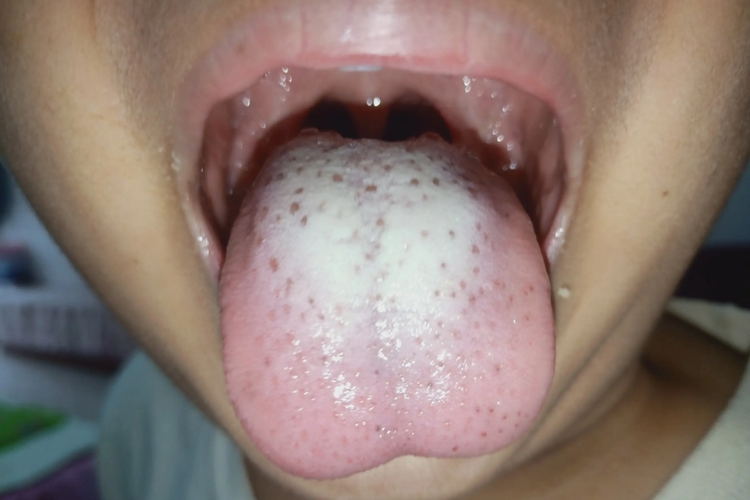 积食白厚腻舌苔图