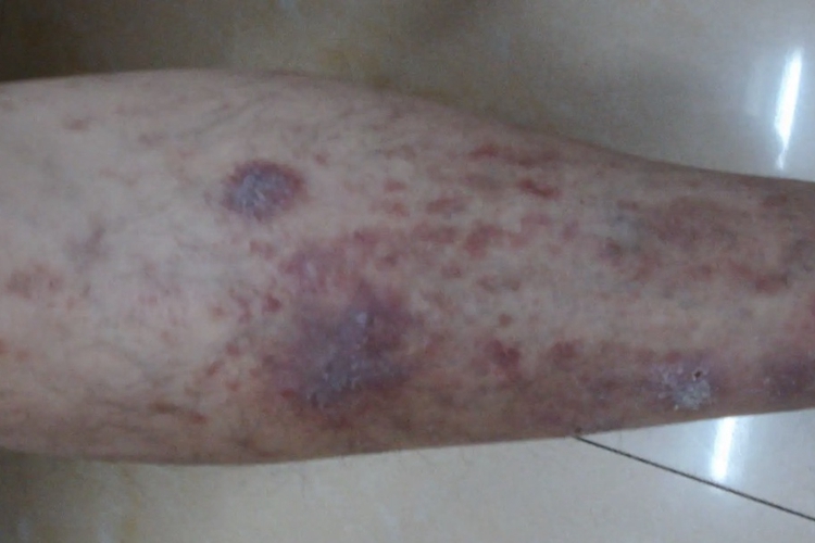 小腿湿疹红色斑块图