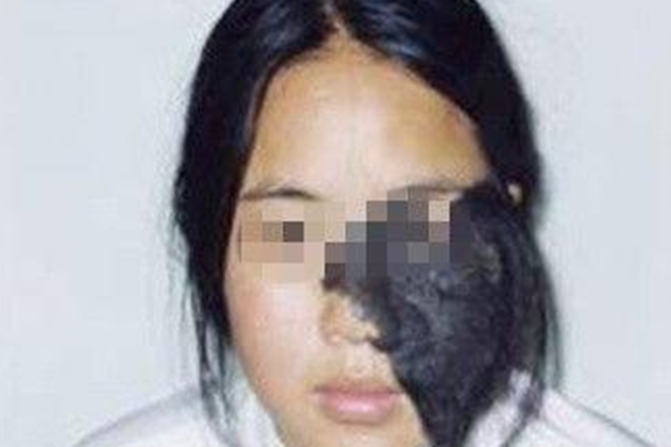 巨大性黑素细胞痣图 巨大性黑素细胞痣图