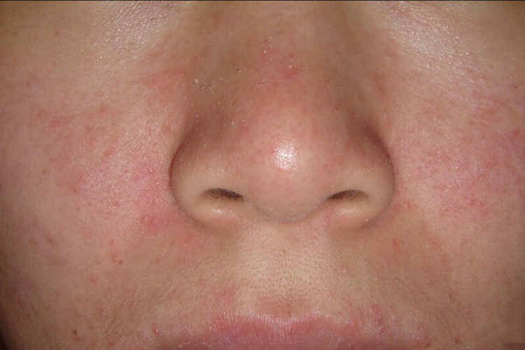 鼻子脂溢性皮炎红色丘疹图 鼻子脂溢性皮炎红色丘疹图
