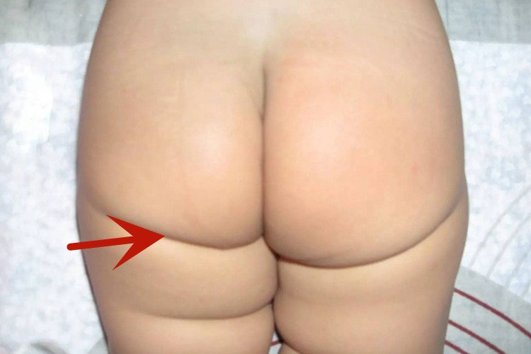 先髋宝宝臀纹不对称图