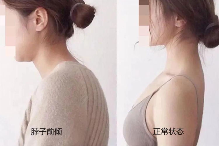 脖子前倾与正常对比图