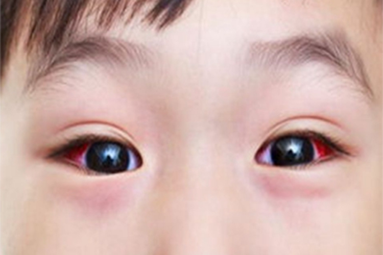 儿童结膜炎充血图