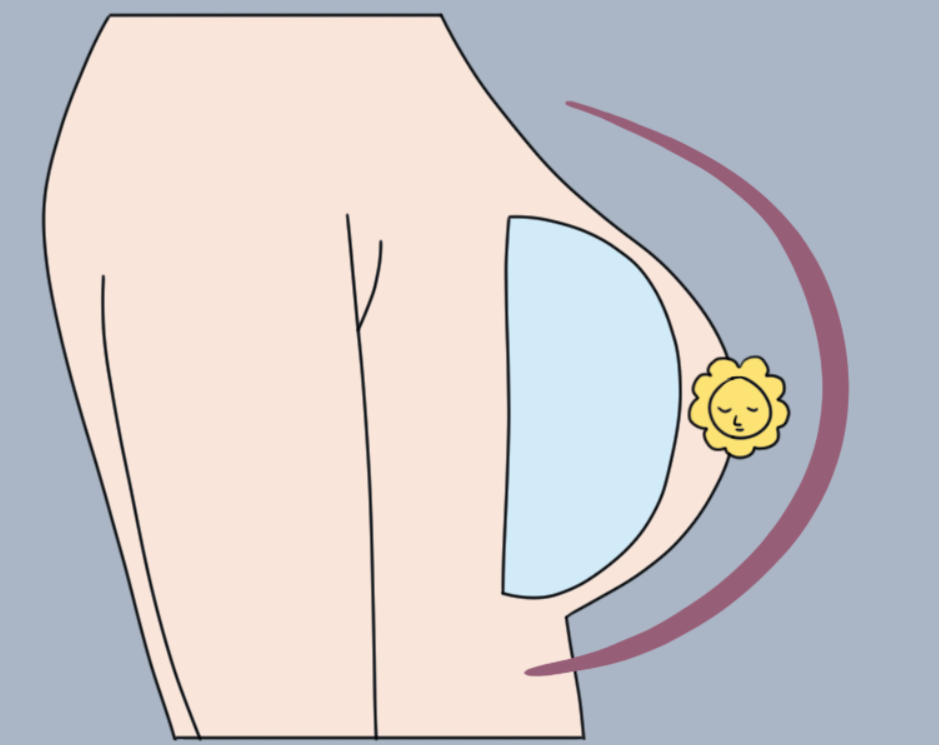 圆形假体隆胸术后图 圆形假体隆胸术后图