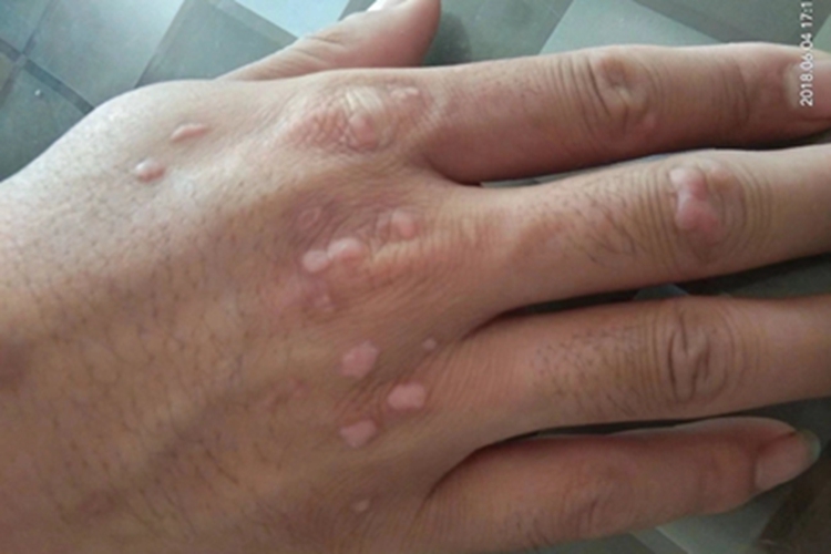 扁平疣手背上有粉红色小疙瘩图