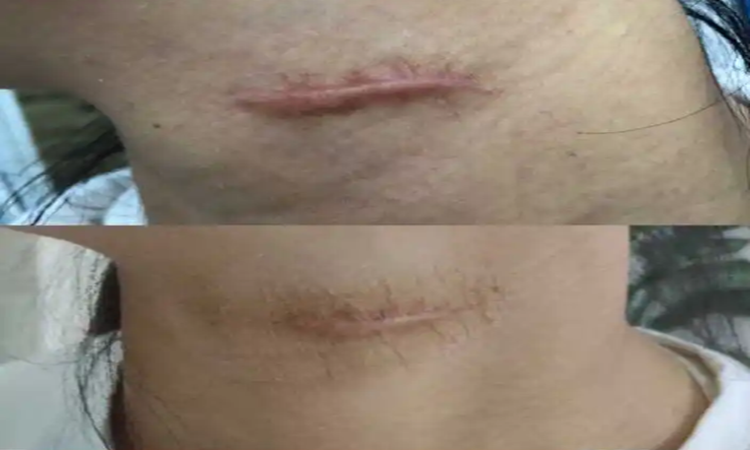 使用软化针前后图