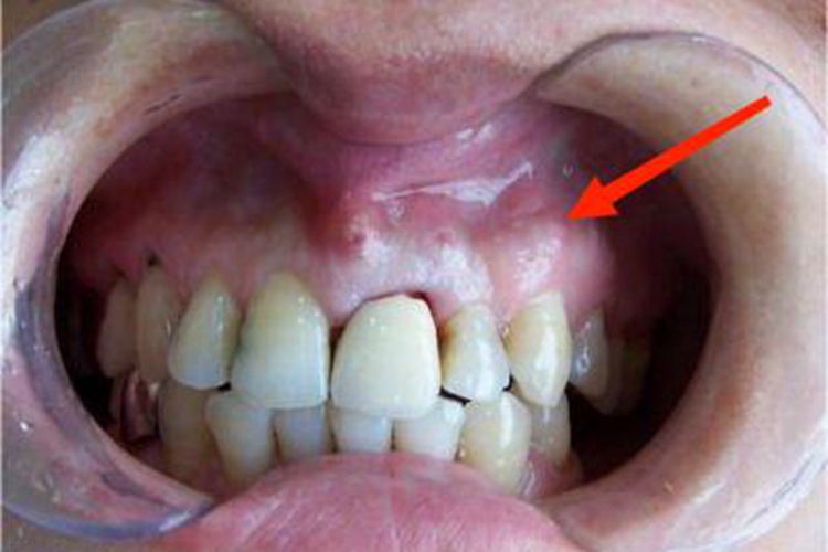 慢性牙周脓肿症状图 慢性牙周脓肿症状图