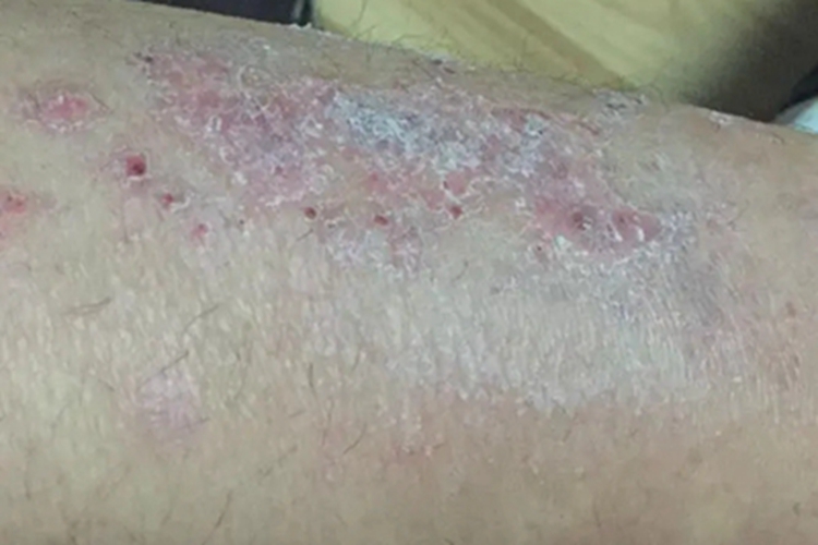 冬季瘙痒症红斑图 冬季瘙痒症红斑图