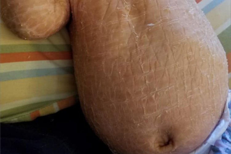 板层状鱼鳞病腹部症状图