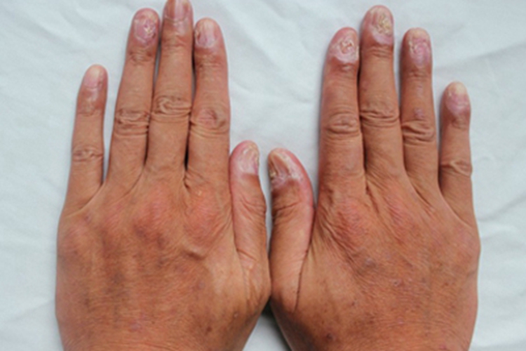 慢性移植物抗宿主病粗糙图 慢性移植物抗宿主病粗糙图