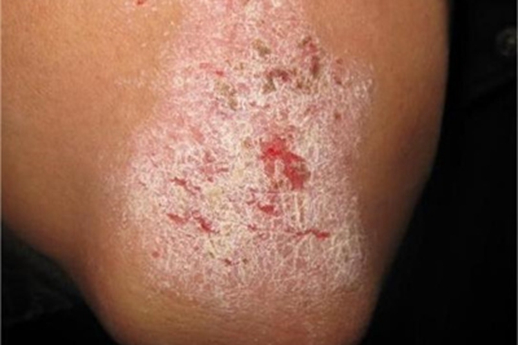 苔藓状淀粉样变糜烂图 苔藓状淀粉样变糜烂图