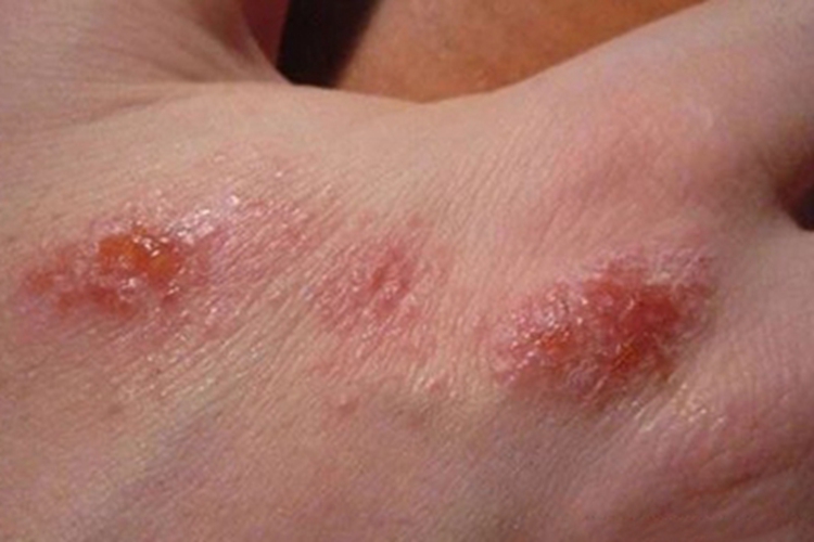 疱疹样湿疹手背上水疱图