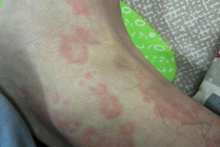 荨麻疹型药疹红斑图 荨麻疹型药疹红斑图